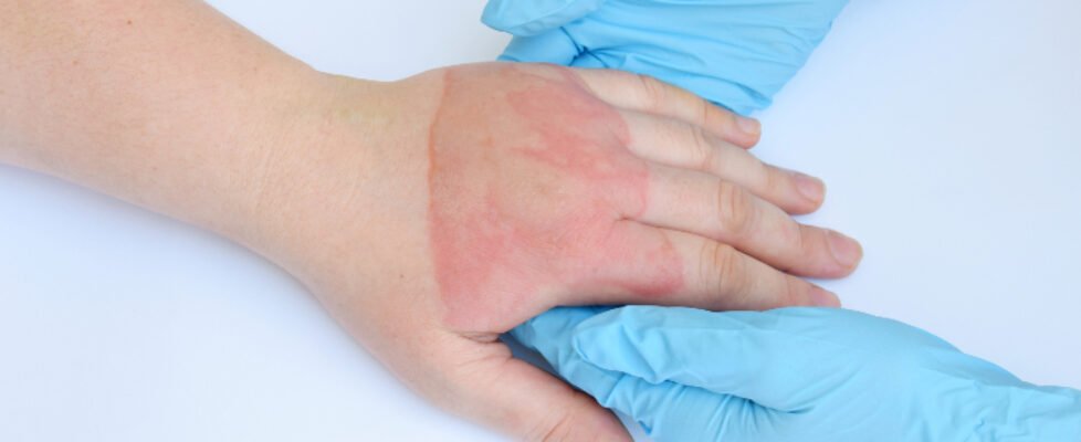 informe_quemados_800x320